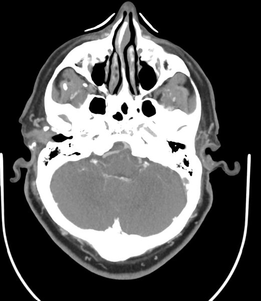 File:Cerebral dural venous sinus thrombosis (Radiopaedia 86514-102576 A 34).jpg