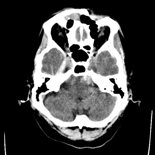 File:Cerebral hemorrhagic contusions (Radiopaedia 23145-23188 Axial non-contrast 7).jpg