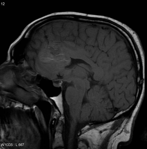 File:Cerebral metastases - renal cell carcinoma (Radiopaedia 5510-7246 Sagittal T1 5).jpg