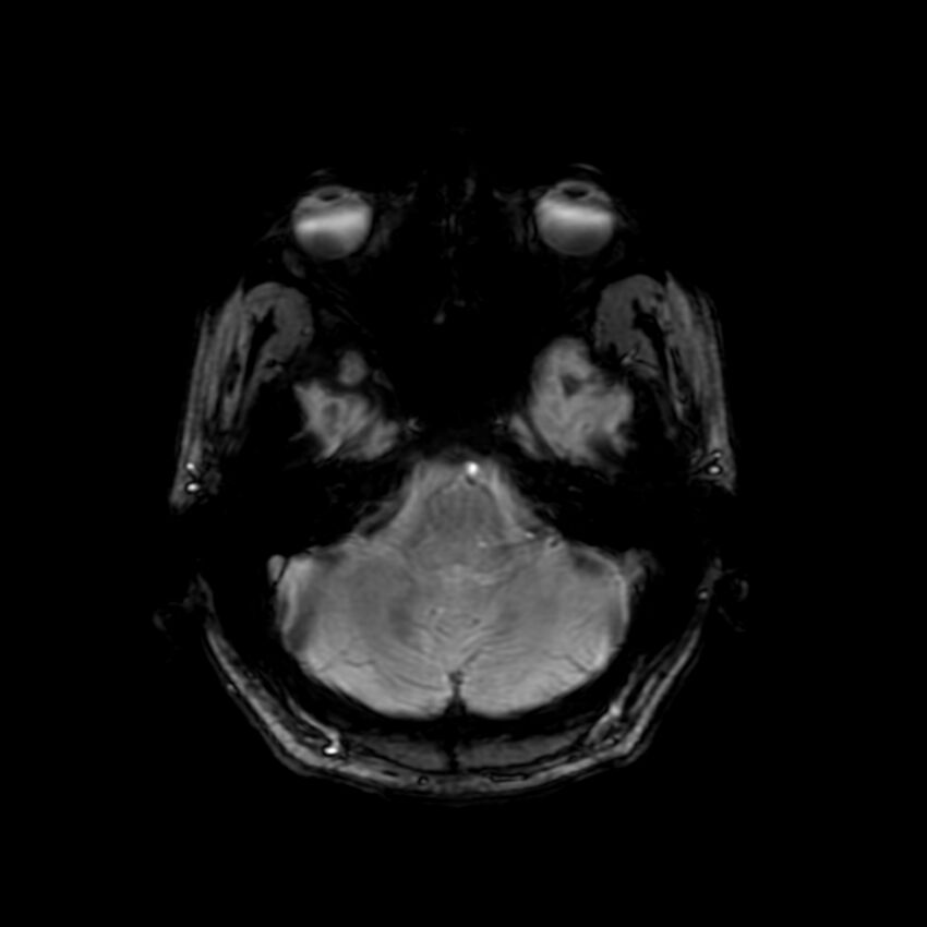 Cerebral paragonimiasis (Radiopaedia 73473-84238 Axial SWI 16).jpg