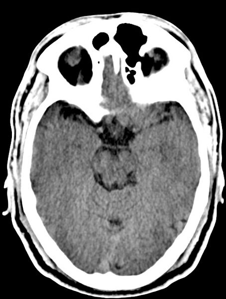 File:Cerebral venous angioma (Radiopaedia 69959-79977 Axial non-contrast 13).jpg