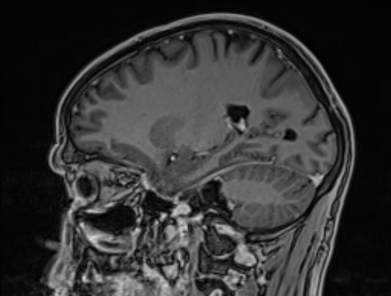 File:Cerebral venous thrombosis (Radiopaedia 71207-81504 Sagittal T1 C+ 21).jpg