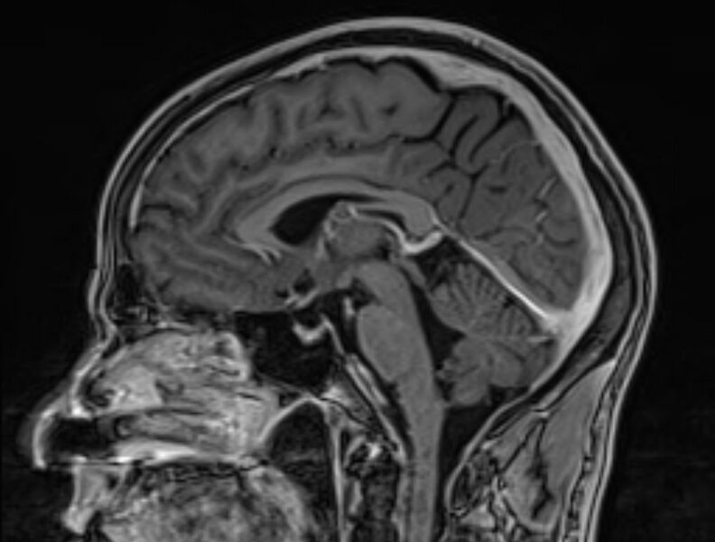 File:Cerebral venous thrombosis (Radiopaedia 71207-81504 Sagittal T1 C+ 30).jpg