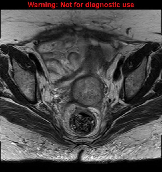 File:Cervical cancer (Radiopaedia 24151-24410 Axial T2 16).jpg