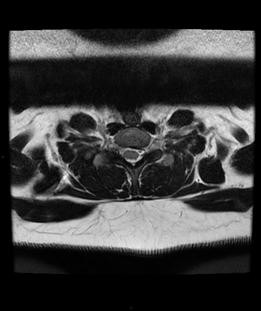 Cervical disc prolapse (Radiopaedia 80258-93598 Axial T2 69).jpg