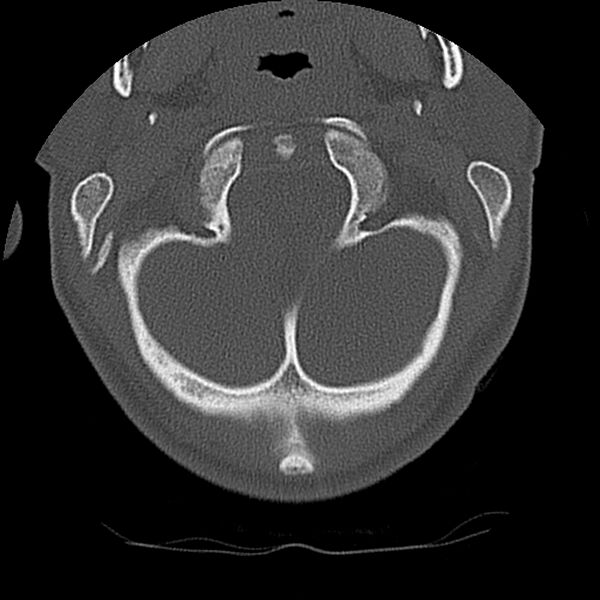 File:Cervical flexion teardrop fracture with cord hemorrhage (Radiopaedia 32497-33454 Axial bone window 11).jpg