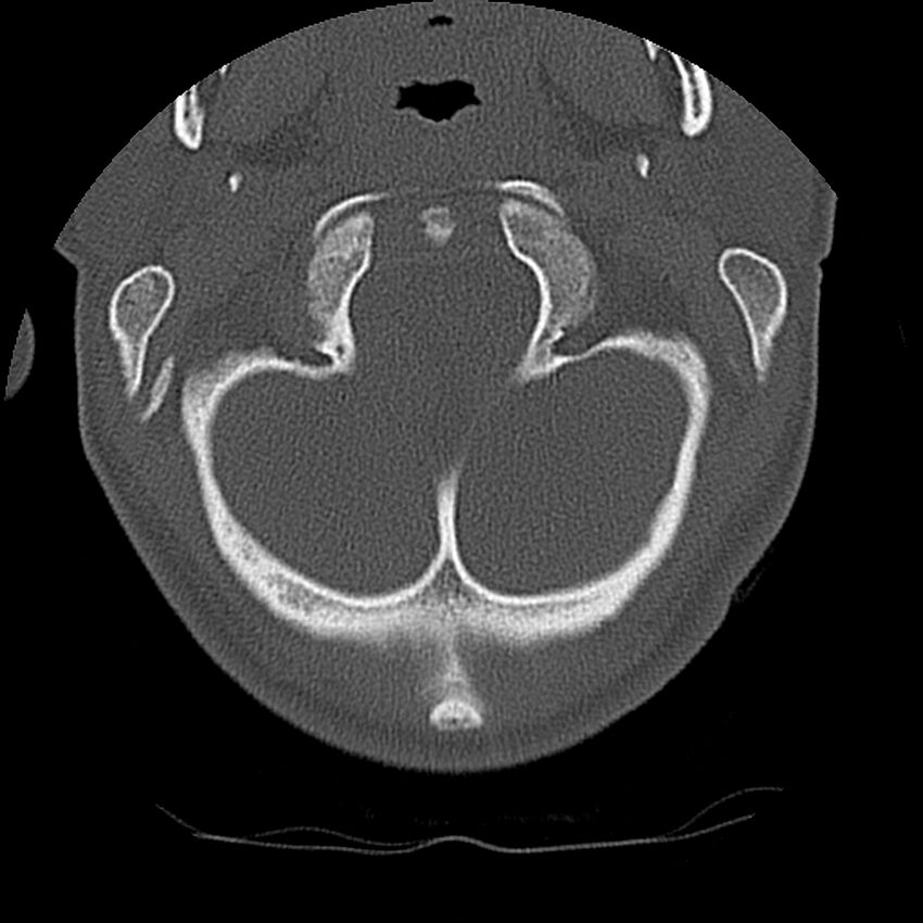 Cervical flexion teardrop fracture with cord hemorrhage (Radiopaedia 32497-33454 Axial bone window 11).jpg