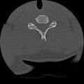 Cervical flexion teardrop fracture with cord hemorrhage (Radiopaedia 32497-33454 Axial bone window 61).jpg