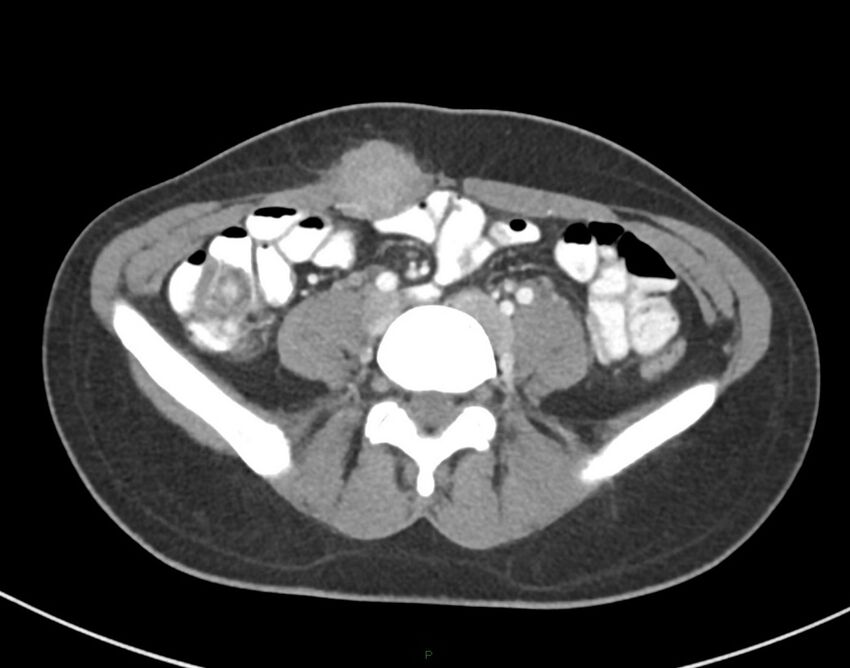 Cesarean scar endometriosis (Radiopaedia 82925-97262 A 55).jpg