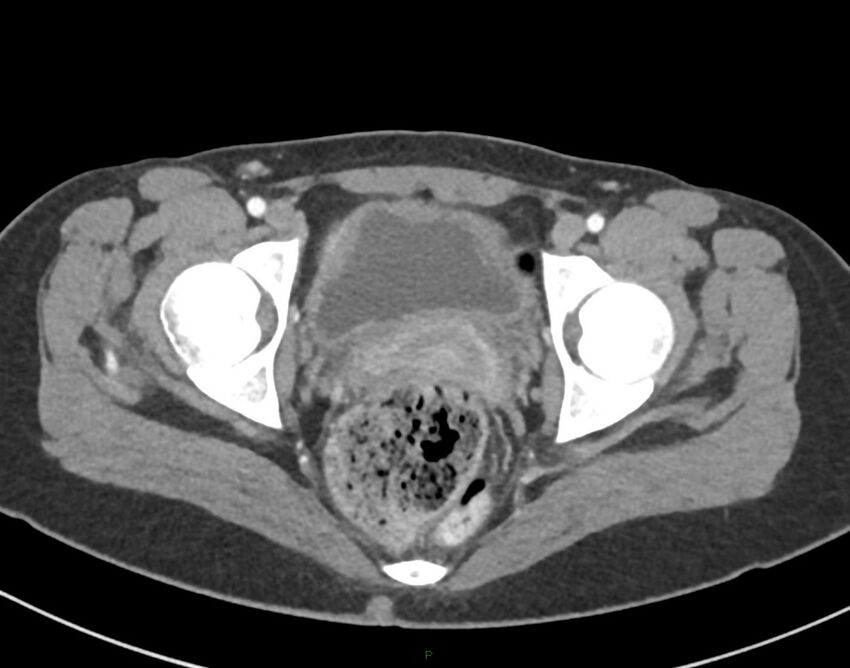 Cesarean scar endometriosis (Radiopaedia 82925-97262 A 81).jpg