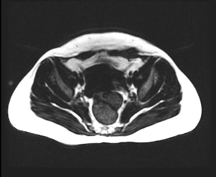 File:Cesarean section scar endometrioma (Radiopaedia 56569-63297 Axial T1 5).jpg
