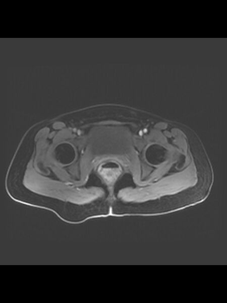 File:Cesarean section scar endometrioma (Radiopaedia 56569-63297 Axial T1 C+ fat sat 6).jpg