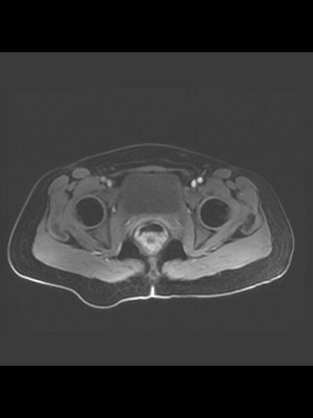 File:Cesarean section scar endometrioma (Radiopaedia 56569-63297 Axial T1 C+ fat sat 7).jpg