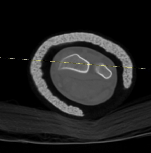 File:Chauffeur's (Hutchinson) fracture (Radiopaedia 58043-65079 Axial 14).png