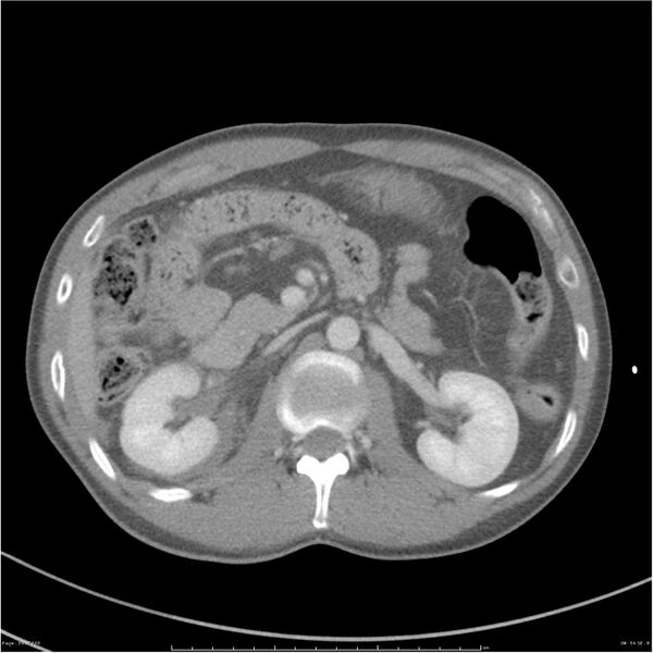 File:Chest and abdomen multi-trauma (Radiopaedia 26294-26426 bone window 34).jpg