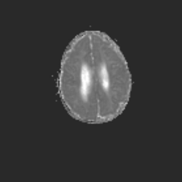 File:Chiari III malformation with occipital encephalocele (Radiopaedia 79446-92559 Axial ADC 17).jpg
