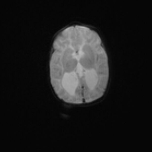 File:Chiari III malformation with occipital encephalocele (Radiopaedia 79446-92559 Axial DWI 14).jpg