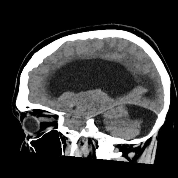 File:Chiasmatic-hypothalamic juvenile pilocytic astrocytoma (Radiopaedia 78533-91237 B 26).jpg