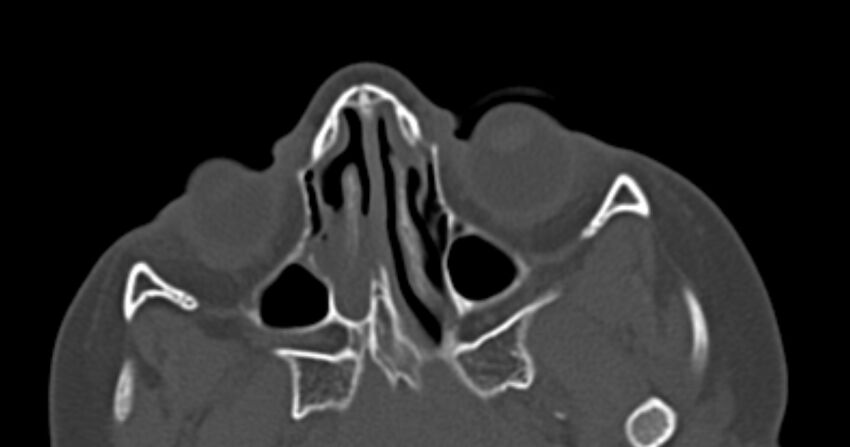 Choanal atresia (Radiopaedia 51295-56972 Axial bone window 32).jpg