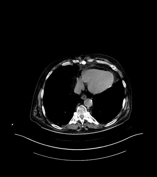 File:Cholangiocarcinoma with cerebral metastases (Radiopaedia 83519-98629 Axial non-contrast 3).jpg