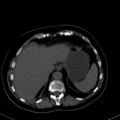 Cholecystitis - CT IVC obstructive choledocholitiasis (Radiopaedia 43966-47479 C 19).png
