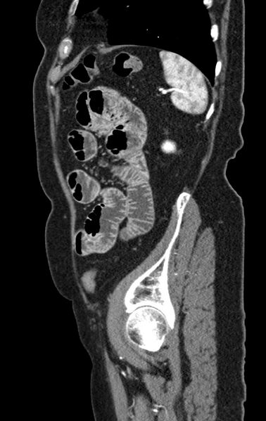 File:Cholecystoduodenal fistula due to calculous cholecystitis with gallstone migration (Radiopaedia 86875-103077 C 12).jpg