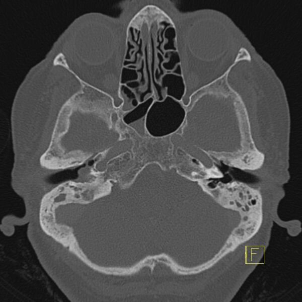 File:Cholesteatomatous chronic otitis (Radiopaedia 14993-14911 Axial bone window 14).JPEG