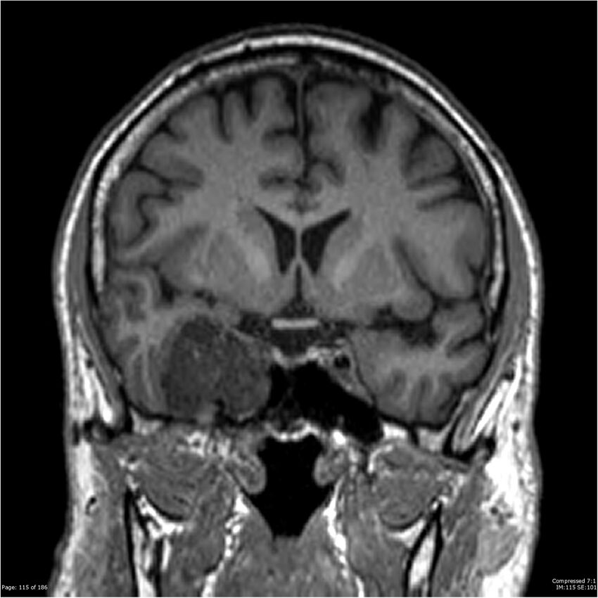 Chondrosarcoma of skull base- grade II (Radiopaedia 40948-43654 Coronal T1 36).jpg