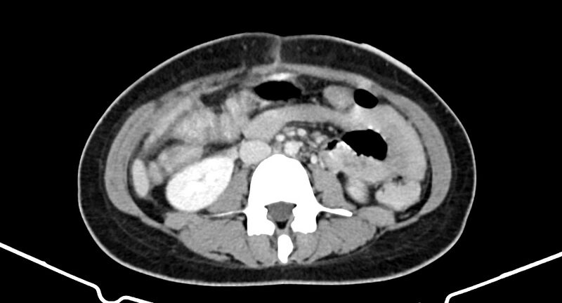 File:Choriocarcinoma liver metastases (Radiopaedia 74768-85766 A 115).jpg