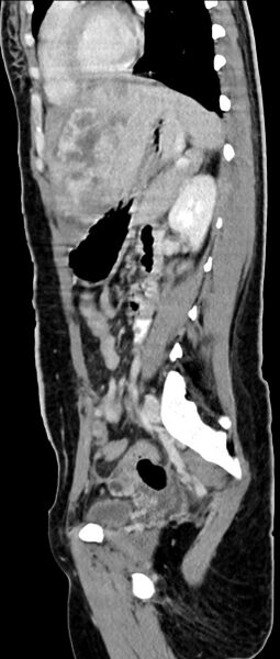 File:Choriocarcinoma liver metastases (Radiopaedia 74768-85766 C 80).jpg