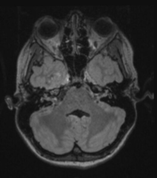 File:Choroid plexus carcinoma (Radiopaedia 91013-108553 Axial FLAIR C+ 95).jpg