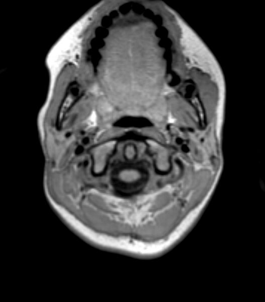 File:Choroid plexus carcinoma (Radiopaedia 91013-108553 Axial T1 15).jpg