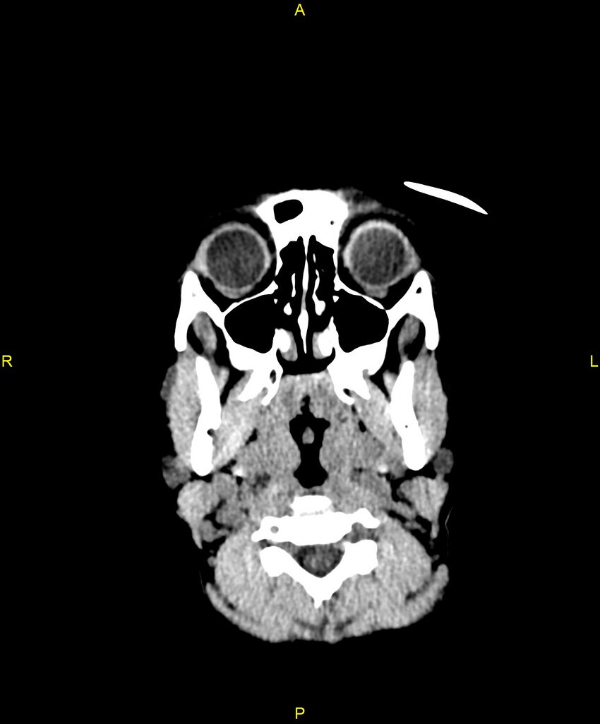 Choroidal fissure cyst (Radiopaedia 89481-106465 Axial non-contrast 2).jpg