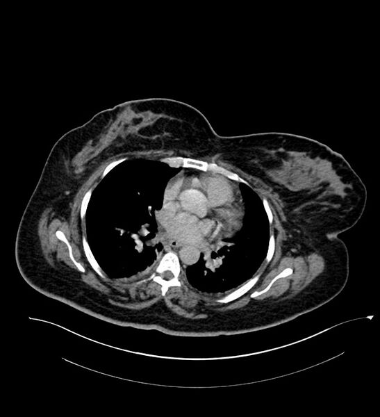 File:Chromophobe renal cell carcinoma (Radiopaedia 84239-99519 E 6).jpg