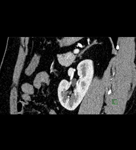 File:Chromophobe renal cell carcinoma (Radiopaedia 84286-99573 F 53).jpg