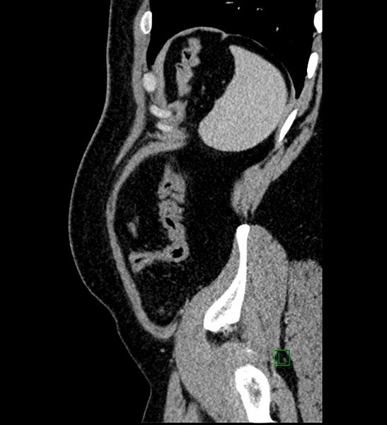 File:Chromophobe renal cell carcinoma (Radiopaedia 84286-99573 I 21).jpg