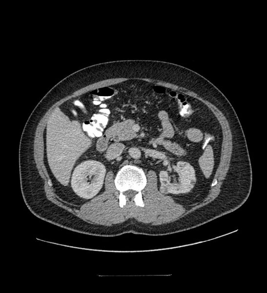 File:Chromophobe renal cell carcinoma (Radiopaedia 84337-99644 C 51).jpg