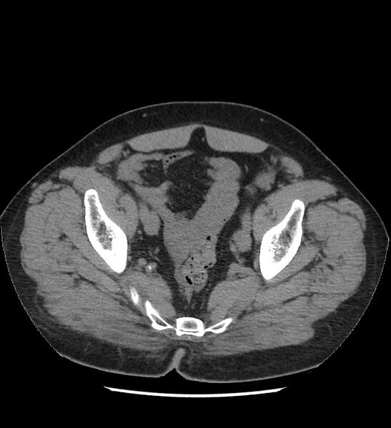 File:Chromophobe renal cell carcinoma (Radiopaedia 86879-103083 Axial non-contrast 110).jpg