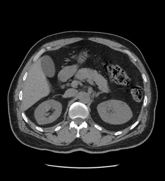 File:Chromophobe renal cell carcinoma (Radiopaedia 86879-103083 Axial non-contrast 26).jpg