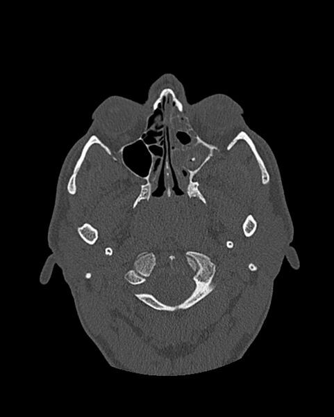 File:Chronic maxillary sinusitis caused by a foreign body (Radiopaedia 58521-65676 Axial bone window 163).jpg