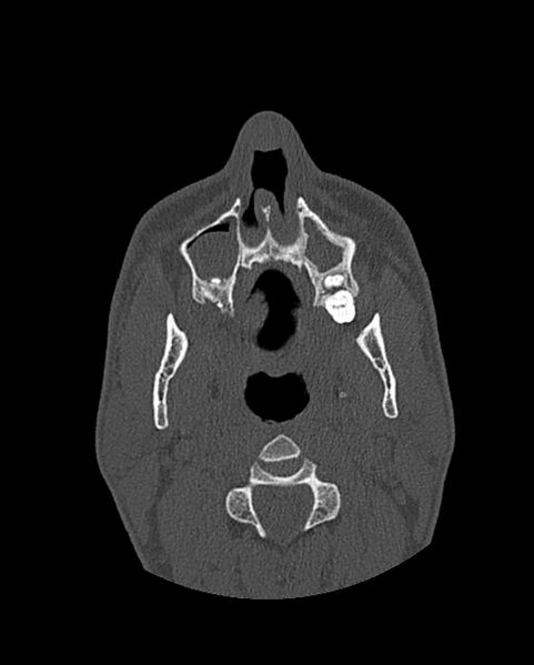 File:Chronic maxillary sinusitis caused by a foreign body (Radiopaedia 58521-65676 Axial bone window 60).jpg