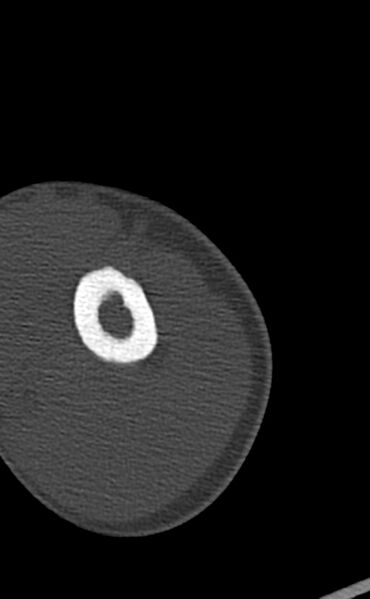 File:Chronic osteomyelitis of the distal humerus (Radiopaedia 78351-90971 Axial 95).jpg