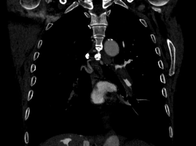 File:Chronic pulmonary embolism (Radiopaedia 91241-108843 A 68).jpg