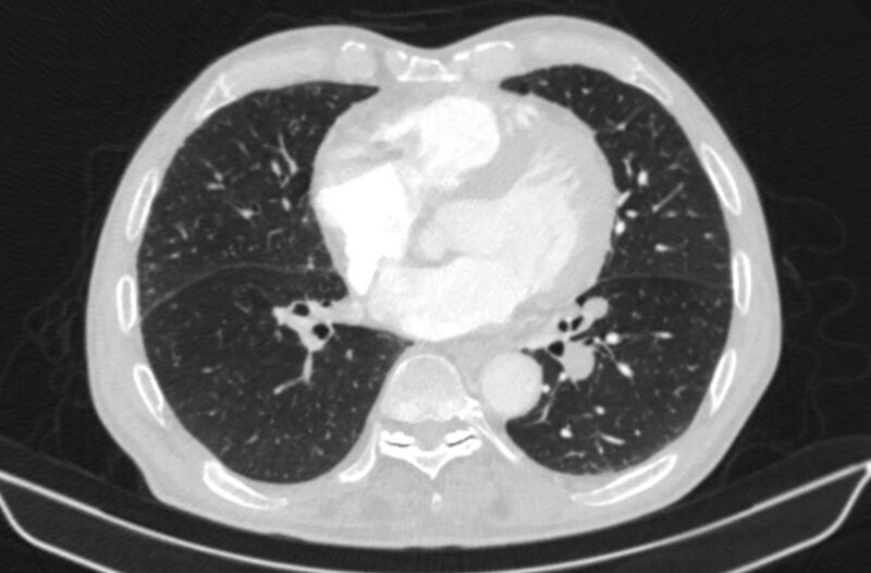 File:Chronic pulmonary embolism (Radiopaedia 91241-108843 Axial lung window 58).jpg