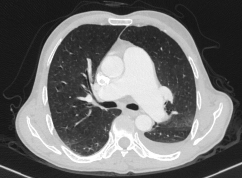 Chronic pulmonary embolism with bubbly consolidation (Radiopaedia 91248-108850 Axial lung window 72).jpg