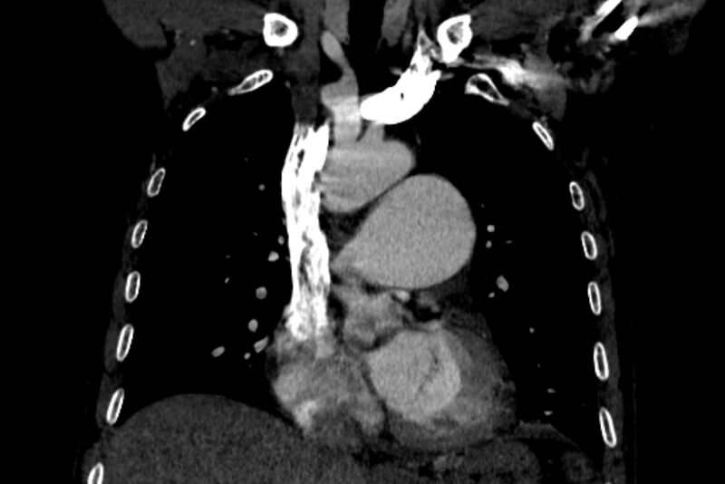 File:Chronic pulmonary embolism with bubbly consolidation (Radiopaedia 91248-108850 B 60).jpg