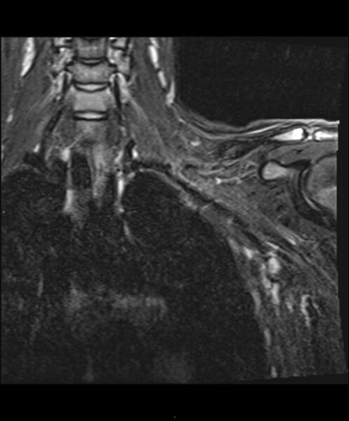 File:Chronic reactive multifocal osteomyelitis (CRMO) - clavicle (Radiopaedia 56406-63114 Coronal STIR 8).jpg