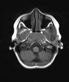 Chronic reactive multifocal osteomyelitis (CRMO) - mandible (Radiopaedia 56405-63069 Axial T1 20).jpg