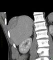 Chronic subcapsular hepatic hematoma (Radiopaedia 29548-30051 C 1).jpg