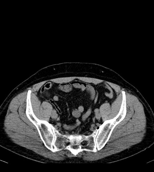 File:Clear cell renal cell carcinoma (Radiopaedia 85006-100539 Axial non-contrast 71).jpg